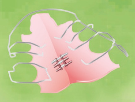拡大床