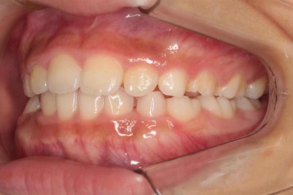 症例3 After